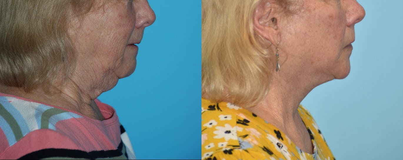 Facelift And Necklift Before & After Gallery - Patient 106387438 - Image 1