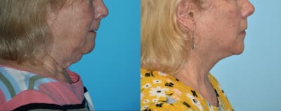 Facelift And Necklift Before & After Gallery - Patient 106387438 - Image 1
