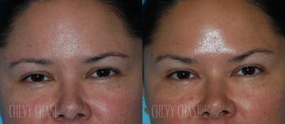 Botox® / Wrinkle Treatments Before & After Gallery - Patient 106387436 - Image 1
