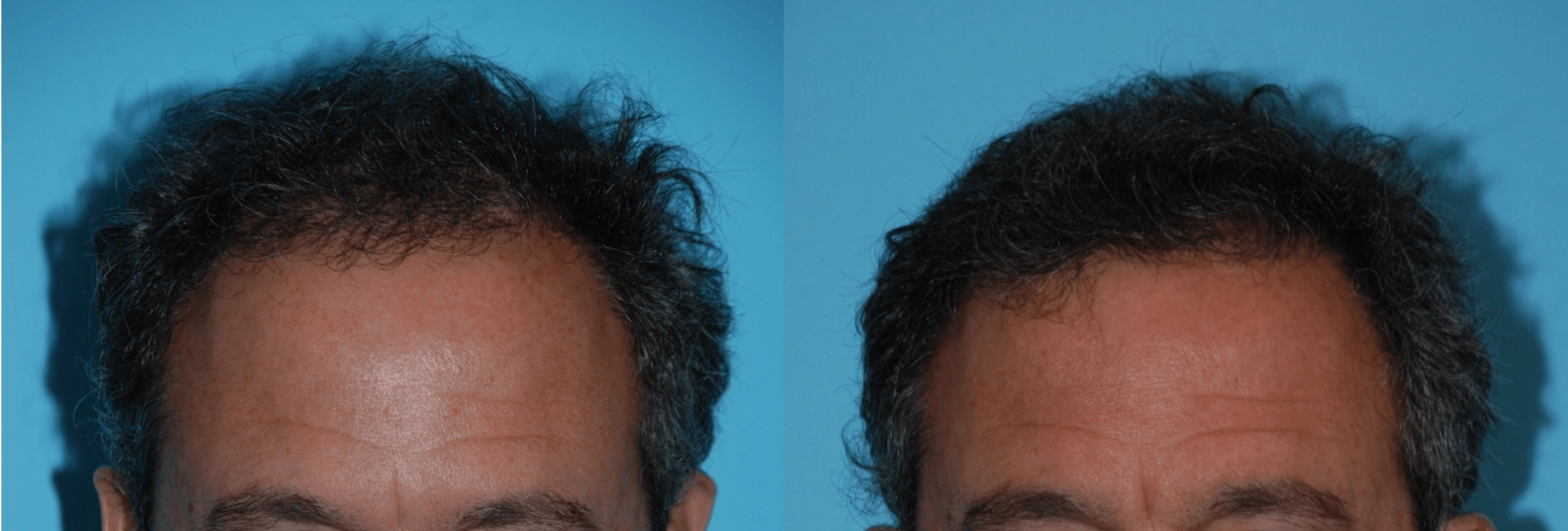 Hair Transplantation Before & After Gallery - Patient 106387441 - Image 3
