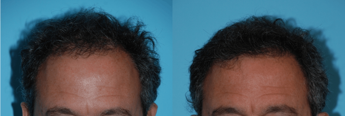Hair Transplantation Before & After Gallery - Patient 106387441 - Image 3