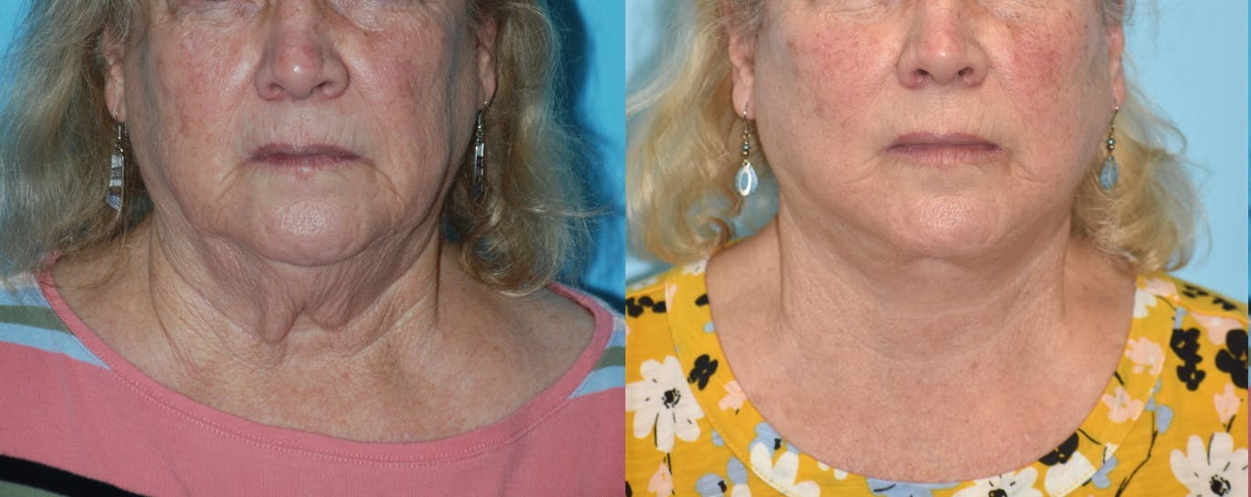 Facelift And Necklift Before & After Gallery - Patient 106387438 - Image 2