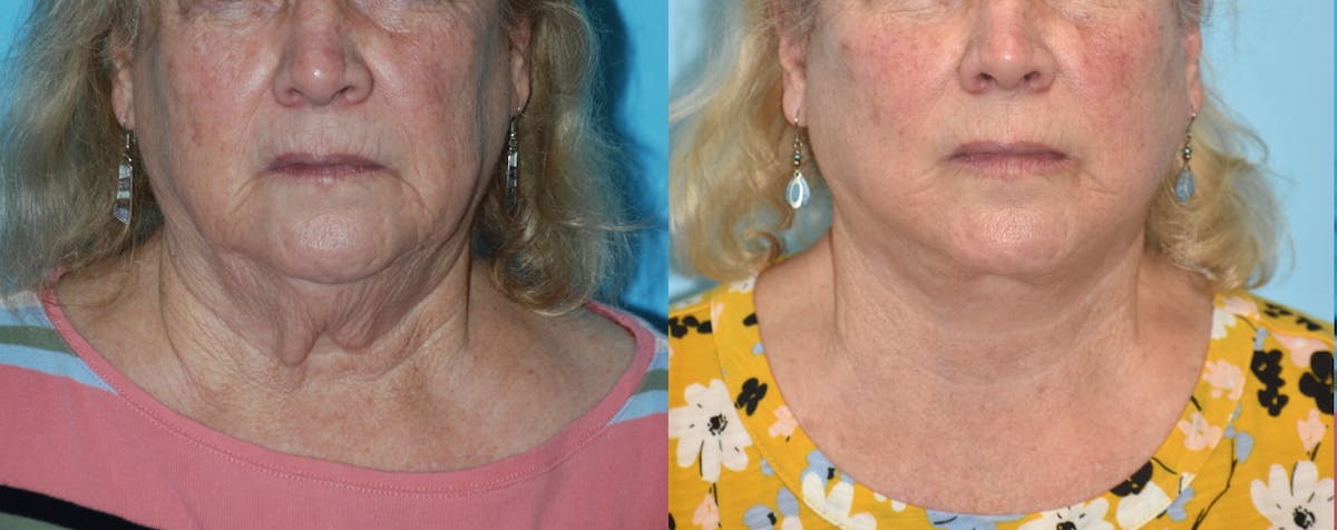 Facelift And Necklift Before & After Gallery - Patient 106387438 - Image 2