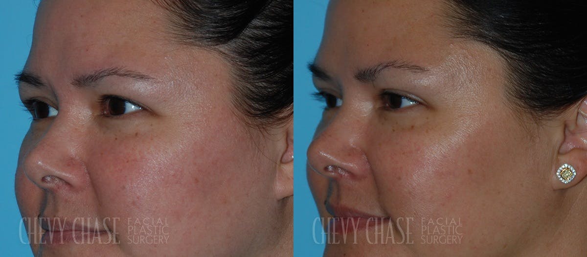Botox® / Wrinkle Treatments Before & After Gallery - Patient 106387436 - Image 2
