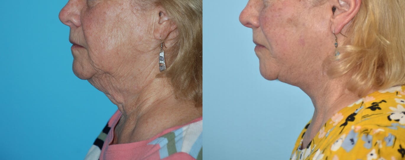 Facelift And Necklift Before & After Gallery - Patient 106387438 - Image 3