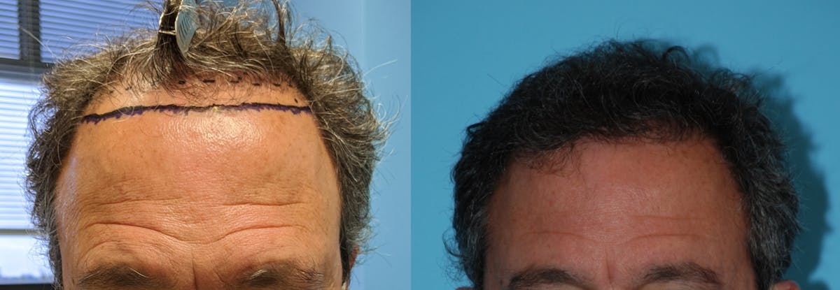 Hair Transplantation Before & After Gallery - Patient 106387441 - Image 4