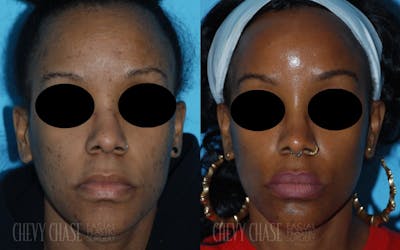 Aerolase Neo® Before & After Gallery - Patient 106387443 - Image 1