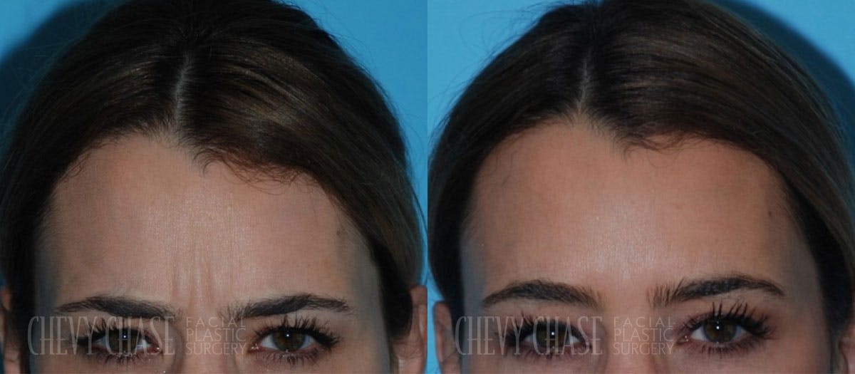 Botox® / Wrinkle Treatments Before & After Gallery - Patient 106387439 - Image 1