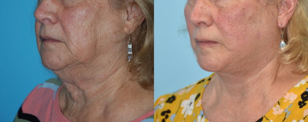 Facelift And Necklift Before & After Gallery - Patient 106387438 - Image 4