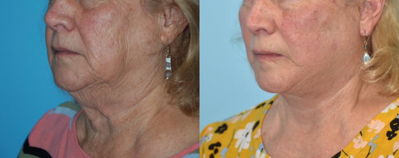 Facelift And Necklift Before & After Gallery - Patient 106387438 - Image 4