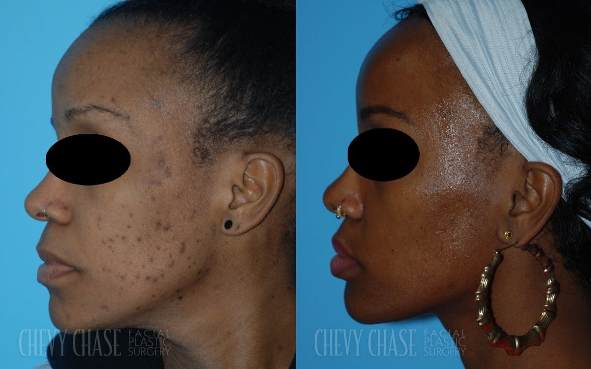 Aerolase Neo® Before & After Gallery - Patient 106387443 - Image 2