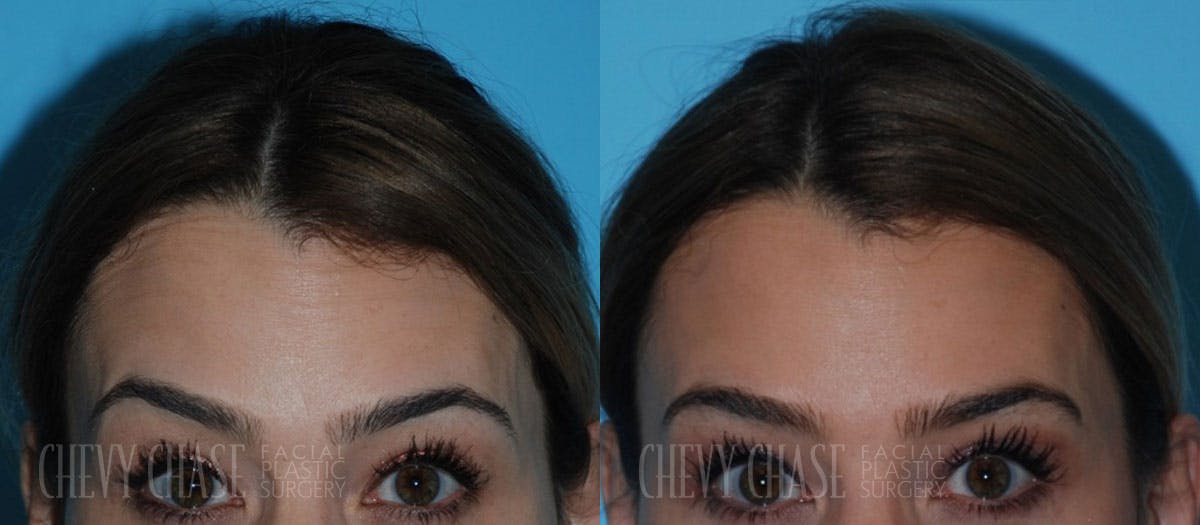 Botox® / Wrinkle Treatments Before & After Gallery - Patient 106387439 - Image 2