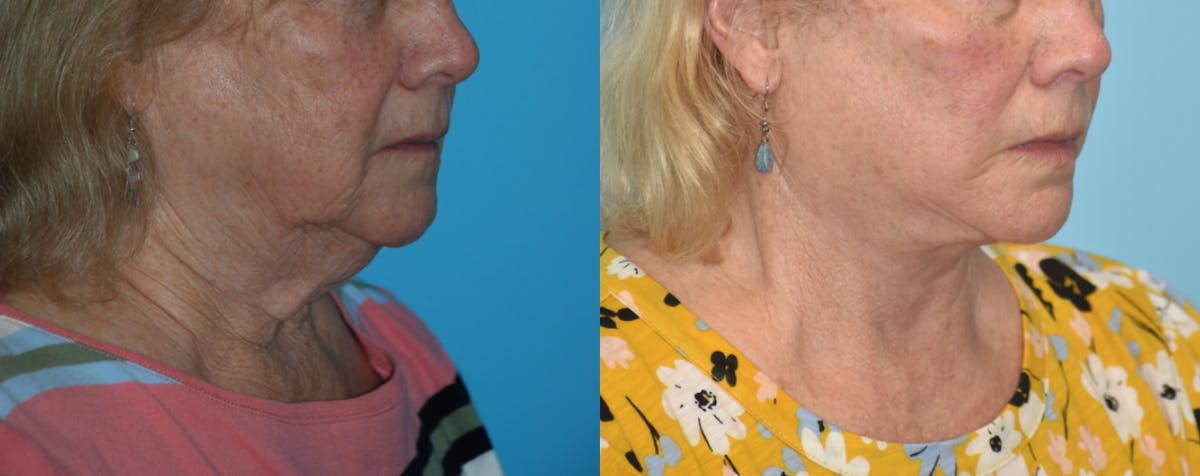 Facelift And Necklift Before & After Gallery - Patient 106387438 - Image 5