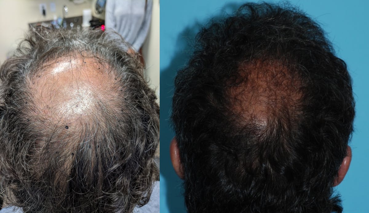 Hair Transplantation Before & After Gallery - Patient 106387441 - Image 5