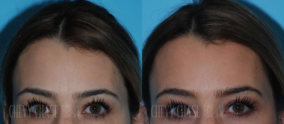 Botox® / Wrinkle Treatments Before & After Gallery - Patient 106387439 - Image 3
