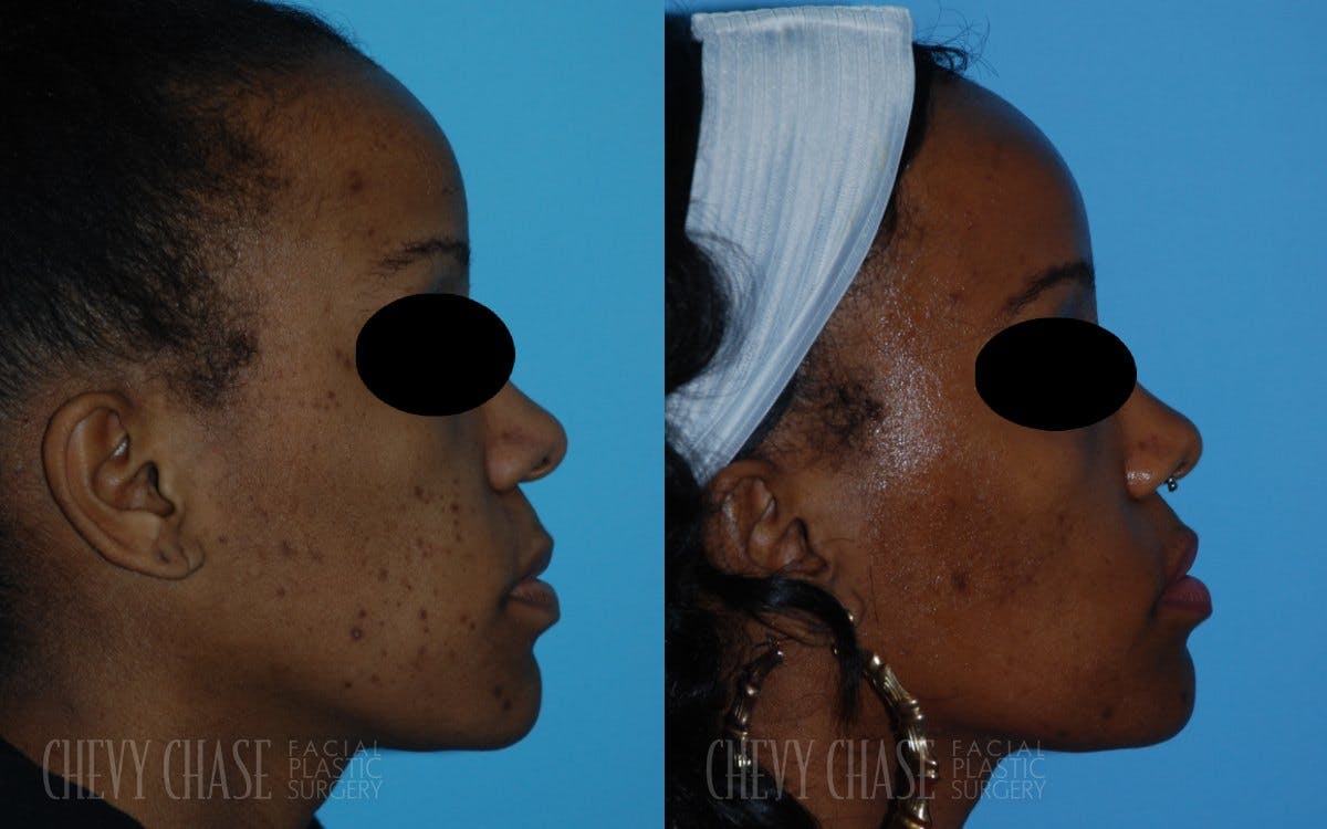 Aerolase Neo® Before & After Gallery - Patient 106387443 - Image 3
