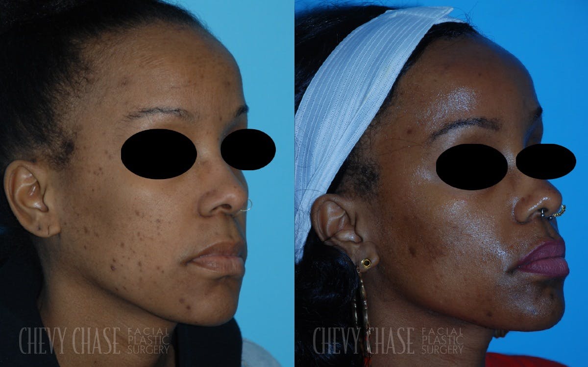Aerolase Neo® Before & After Gallery - Patient 106387443 - Image 4