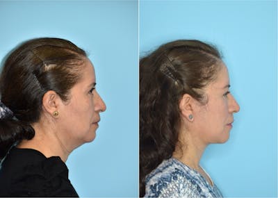 Facelift And Necklift Before & After Gallery - Patient 106387455 - Image 1