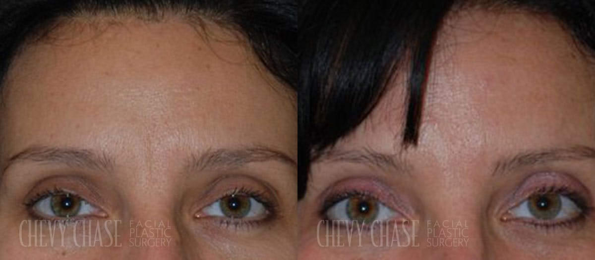 Botox® / Wrinkle Treatments Before & After Gallery - Patient 106387442 - Image 1