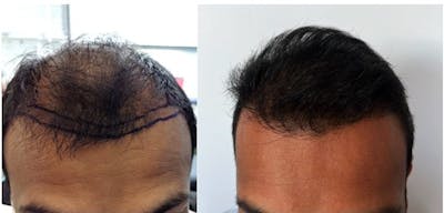 Hair Transplantation Before & After Gallery - Patient 106387446 - Image 1