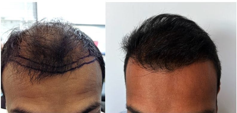 Hair Transplantation Before & After Gallery - Patient 106387446 - Image 1