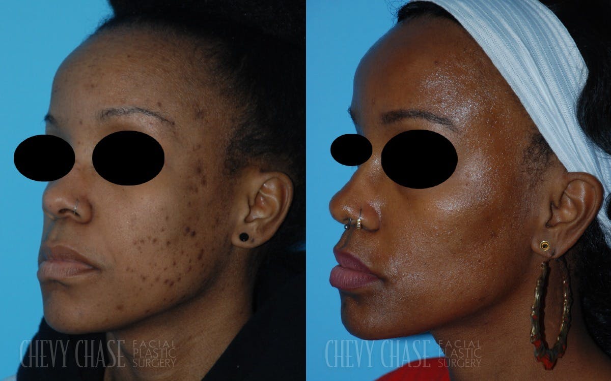 Aerolase Neo® Before & After Gallery - Patient 106387443 - Image 5