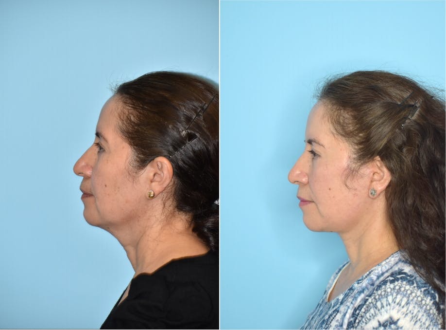 Facelift And Necklift Before & After Gallery - Patient 106387455 - Image 2