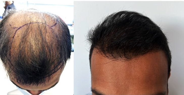 Hair Transplantation Before & After Gallery - Patient 106387446 - Image 2