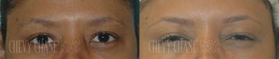 Botox® / Wrinkle Treatments Before & After Gallery - Patient 106387445 - Image 1