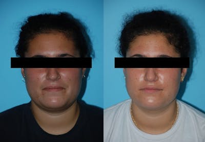 Aerolase Neo® Before & After Gallery - Patient 106387450 - Image 1