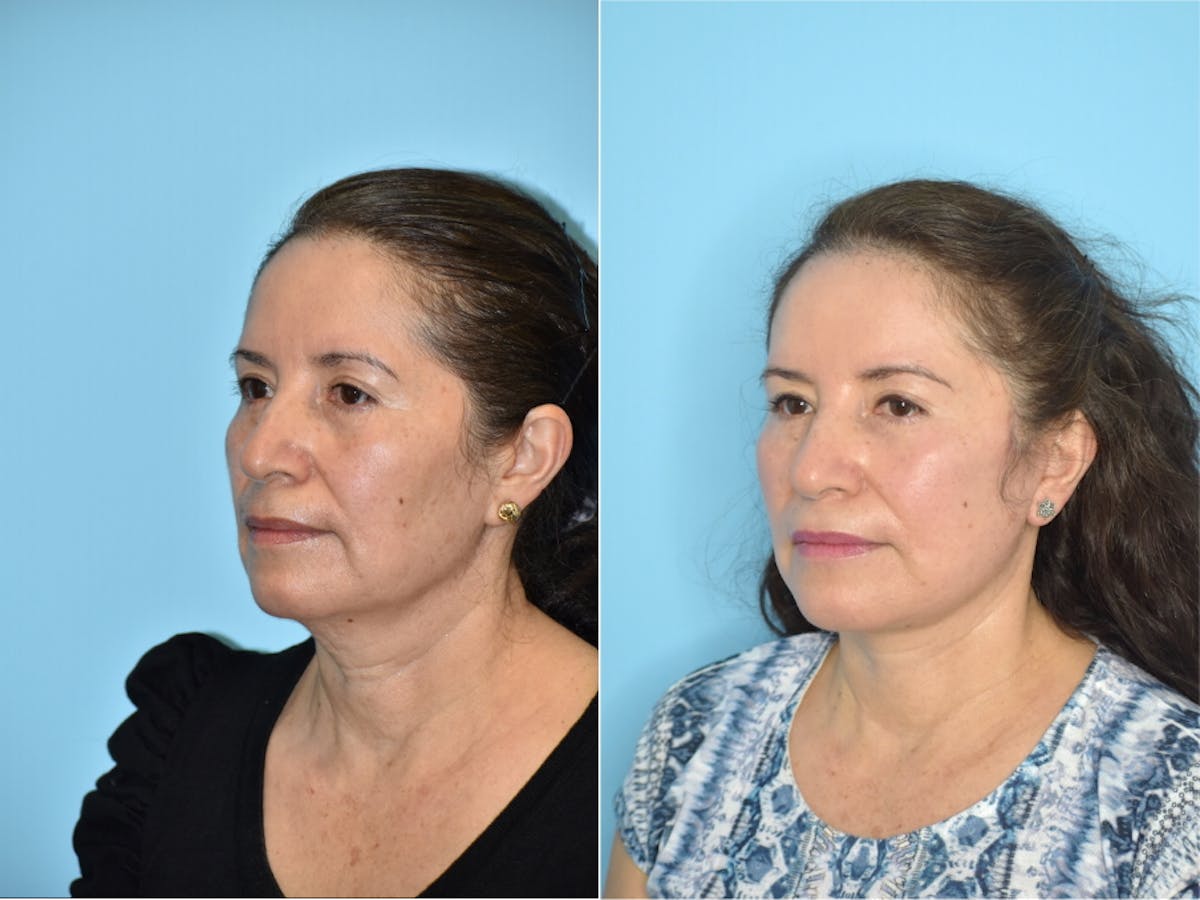 Facelift And Necklift Before & After Gallery - Patient 106387455 - Image 3