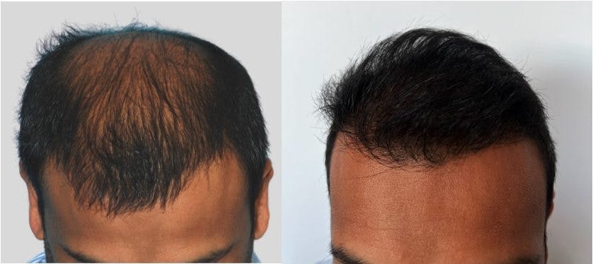 Hair Transplantation Before & After Gallery - Patient 106387446 - Image 3