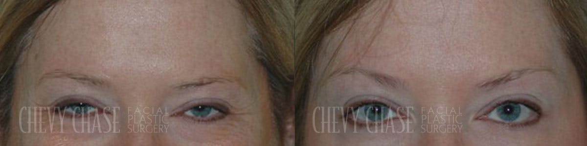 Botox® / Wrinkle Treatments Before & After Gallery - Patient 106387448 - Image 1