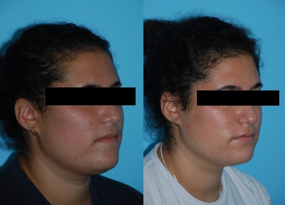 Aerolase Neo® Before & After Gallery - Patient 106387450 - Image 2
