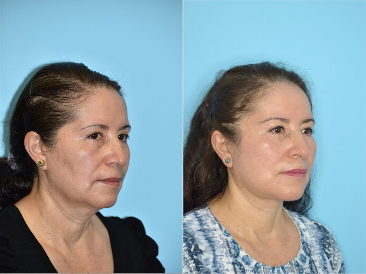 Facelift And Necklift Before & After Gallery - Patient 106387455 - Image 4
