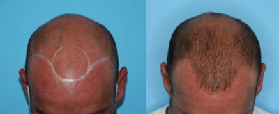 Hair Transplantation Before & After Gallery - Patient 106387451 - Image 1