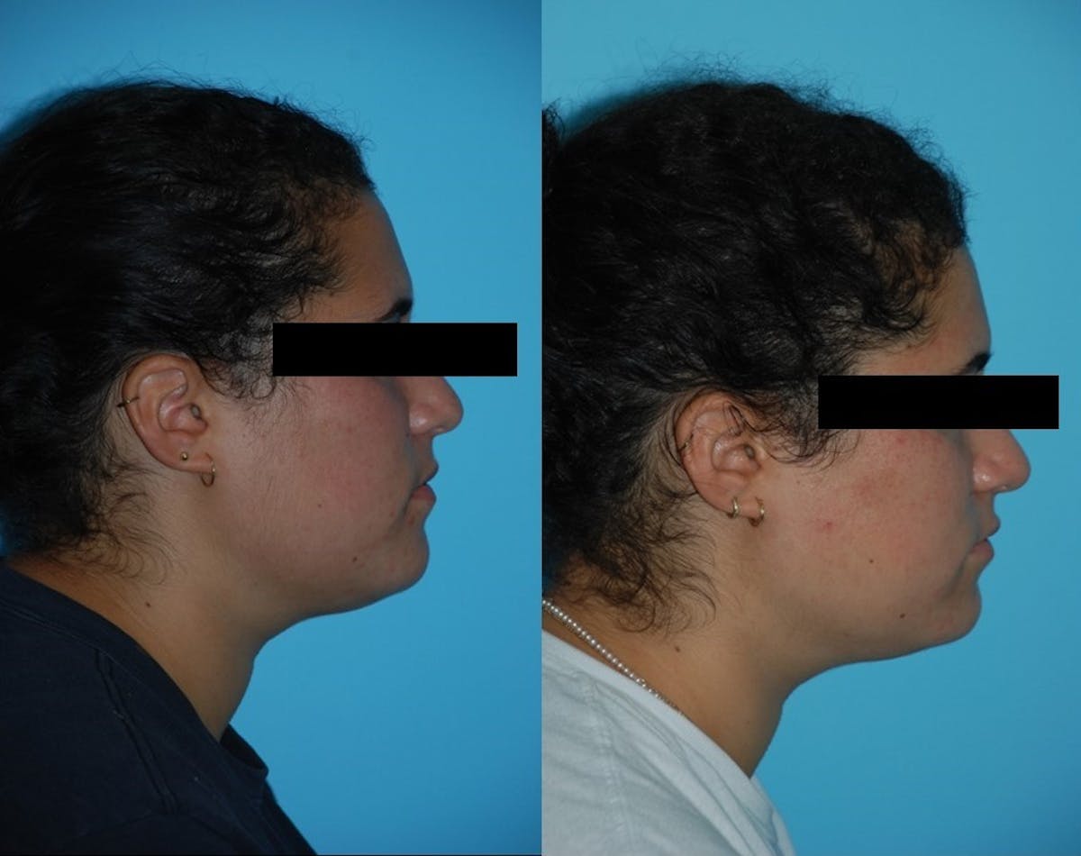Aerolase Neo® Before & After Gallery - Patient 106387450 - Image 3