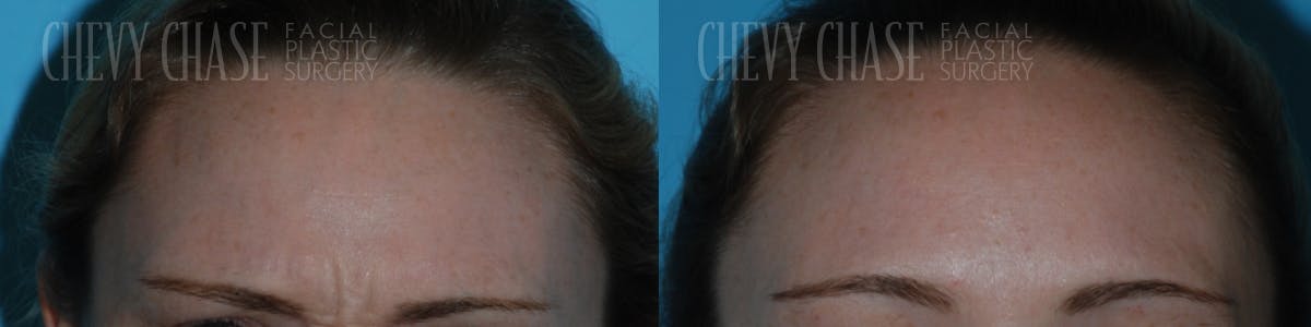 Botox® / Wrinkle Treatments Before & After Gallery - Patient 106387454 - Image 1