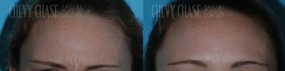Botox® / Wrinkle Treatments Before & After Gallery - Patient 106387454 - Image 1