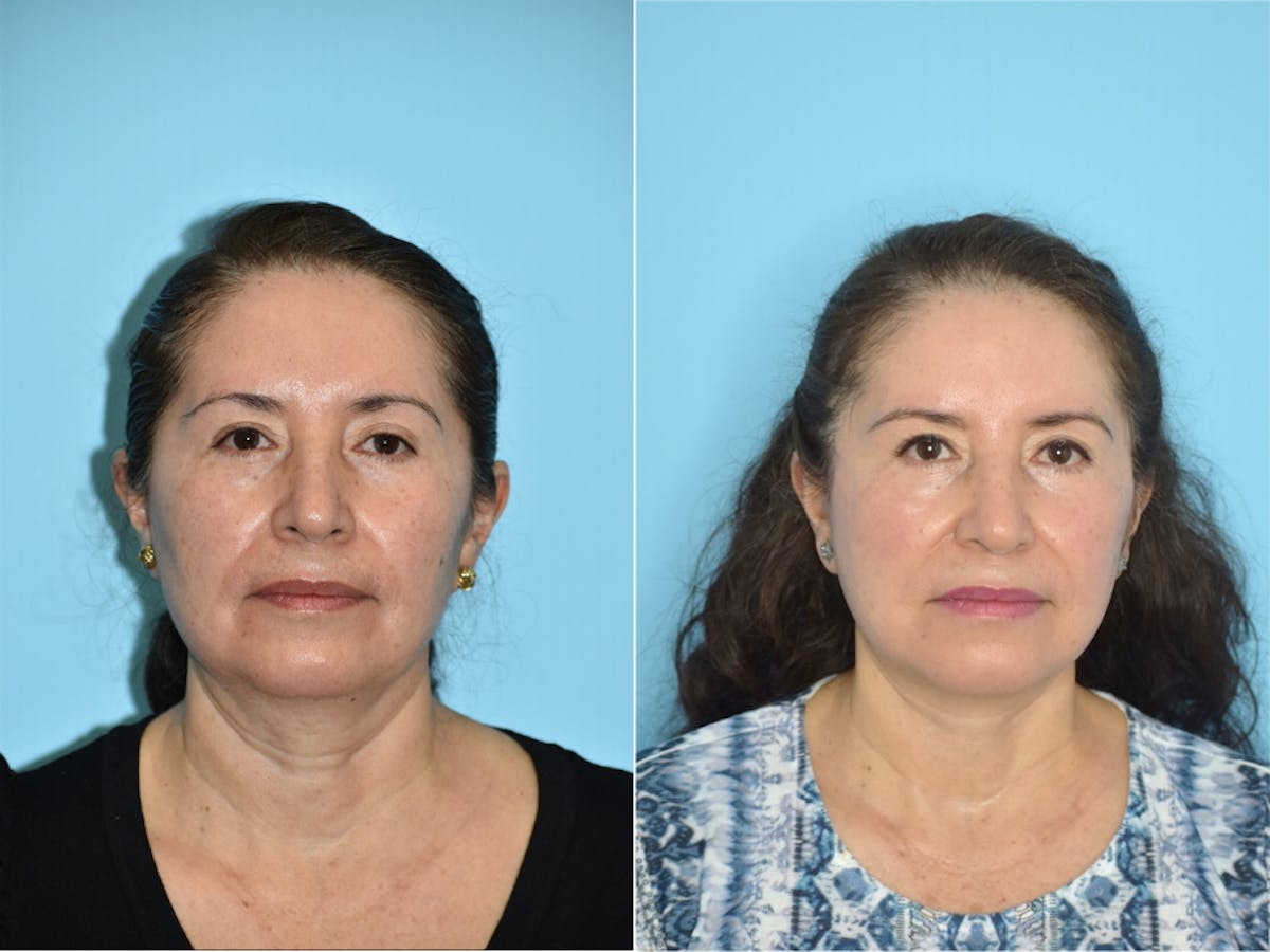 Facelift And Necklift Before & After Gallery - Patient 106387455 - Image 5