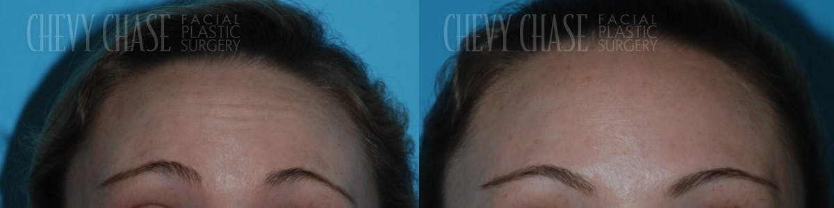 Botox® / Wrinkle Treatments Before & After Gallery - Patient 106387454 - Image 2