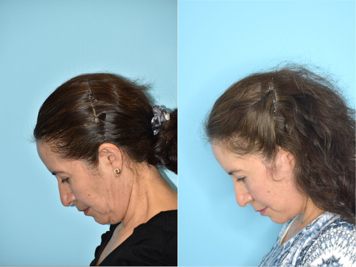 Facelift And Necklift Before & After Gallery - Patient 106387455 - Image 6