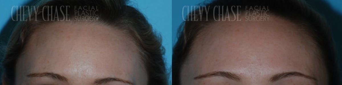 Botox® / Wrinkle Treatments Before & After Gallery - Patient 106387454 - Image 3