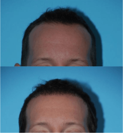 Hair Transplantation Before & After Gallery - Patient 106387456 - Image 1