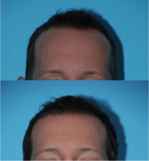 Hair Transplantation Before & After Gallery - Patient 106387456 - Image 1