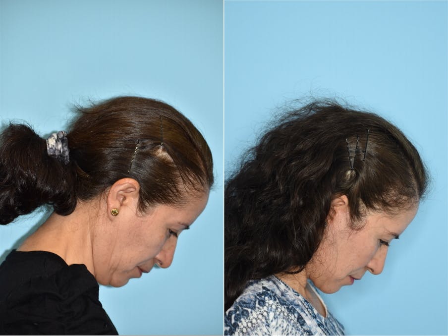 Facelift And Necklift Before & After Gallery - Patient 106387455 - Image 7