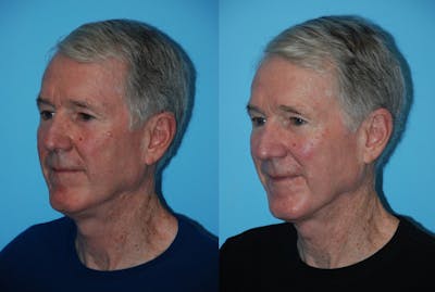 Aerolase Neo® Before & After Gallery - Patient 106387457 - Image 1