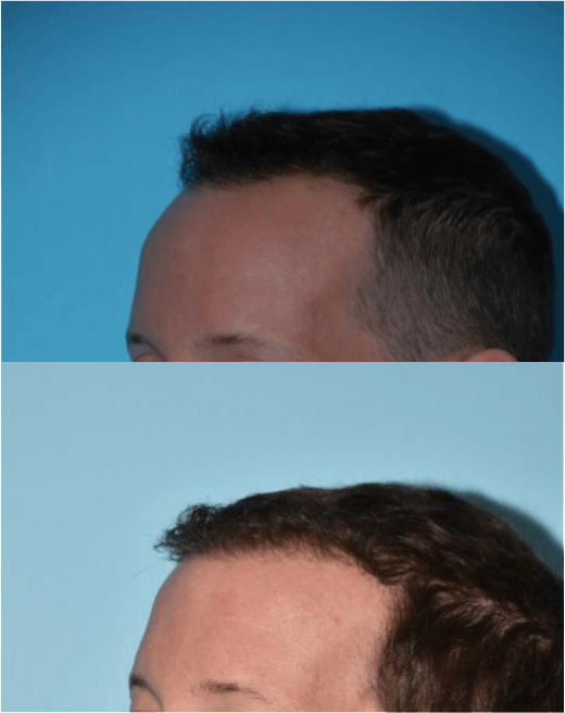 Hair Transplantation Before & After Gallery - Patient 106387456 - Image 2