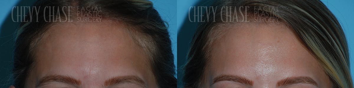 Botox® / Wrinkle Treatments Before & After Gallery - Patient 106387460 - Image 1
