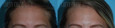 Botox® / Wrinkle Treatments Before & After Gallery - Patient 106387460 - Image 1